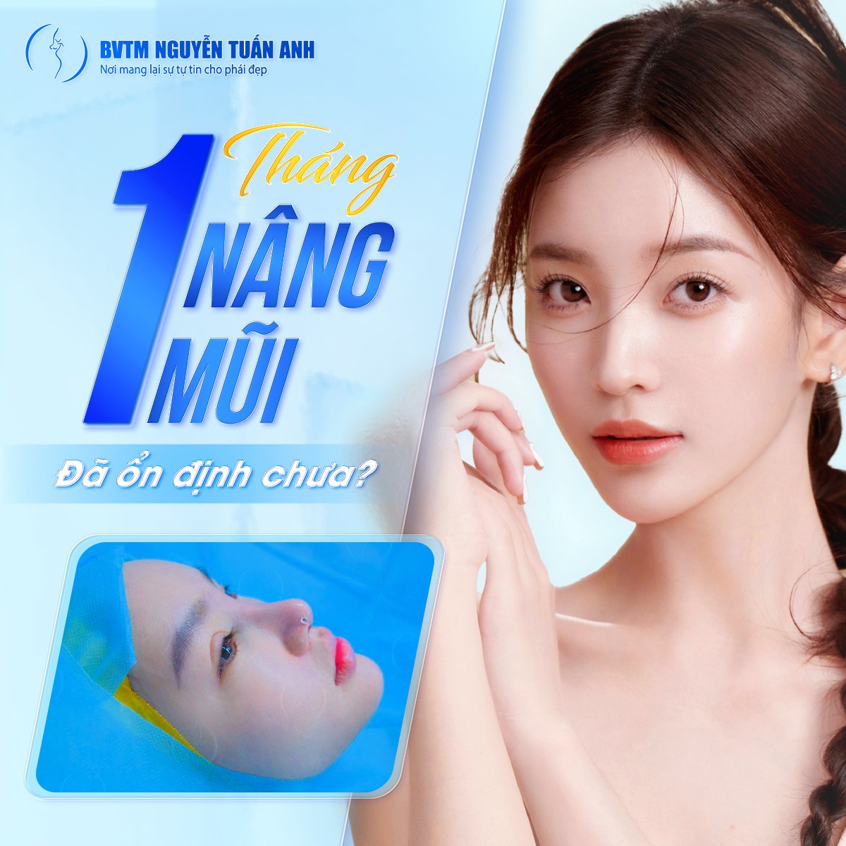 Nâng mũi 1 tháng đã ổn định chưa?