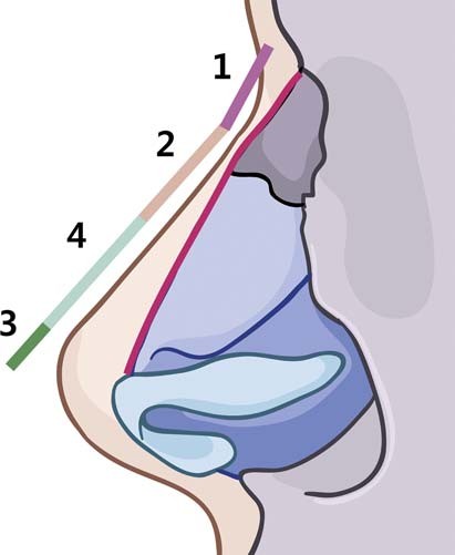 Mũi lộ sóng sau phẫu thì cần sử dụng phương pháp nào?