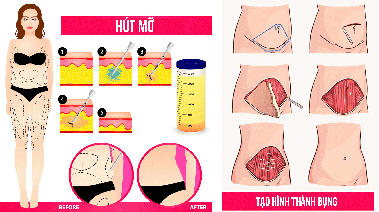 Tạo hình thành bụng khác gì hút mỡ bụng?