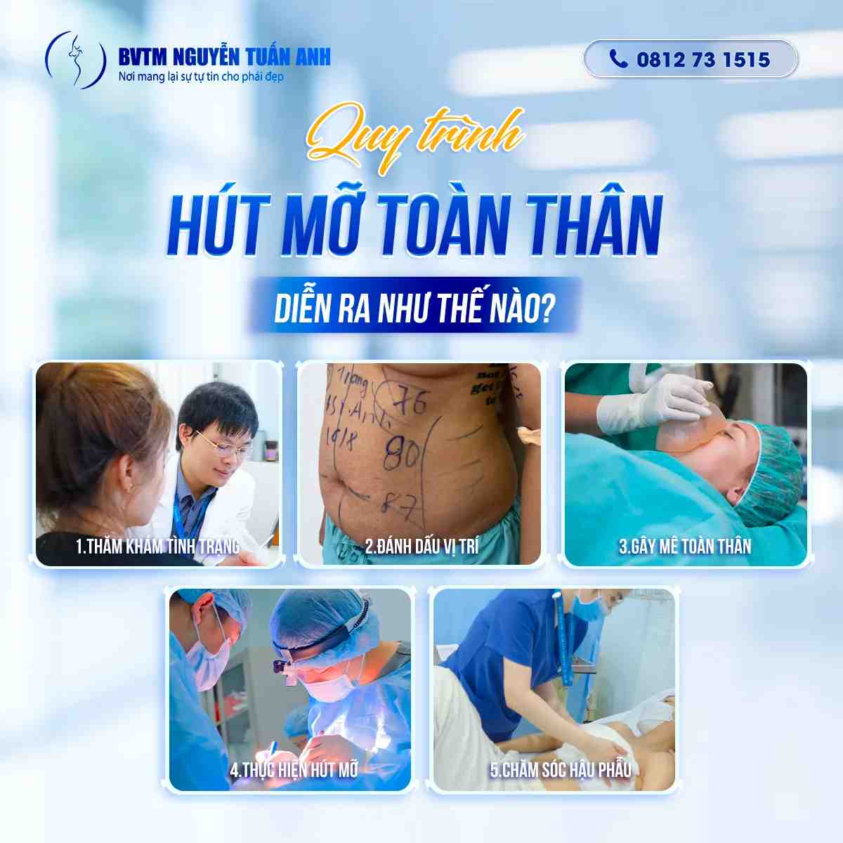 Quy trình hút mỡ toàn thân diễn ra như thế nào?