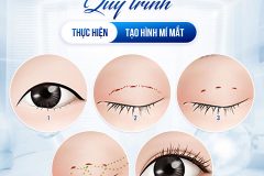 Giải pháp tạo nếp mí tự nhiên cho người bận rộn