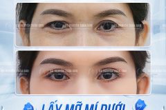 Lấy Mỡ Mí Dưới Có Làm Vùng Mắt Sáng Hơn Không?
