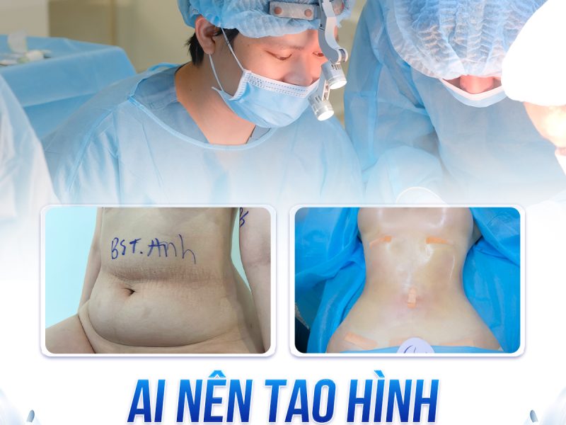 tao-hinh-thanh-bung-khac-gi-hut-mo-bung-
