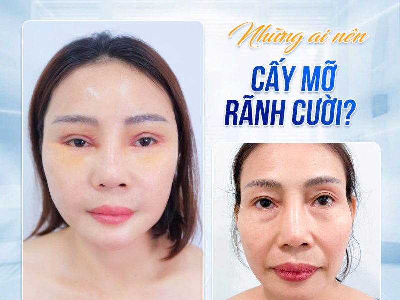 cay-mo-ranh-cuoi-la-gi-phuong-phap-thuc-hien-ra-sao