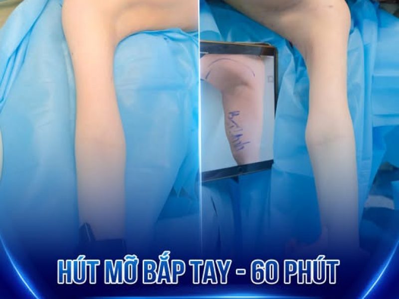 canh-tay-to-tho-het-lo-voi-giai-phap-hut-mo-lipo
