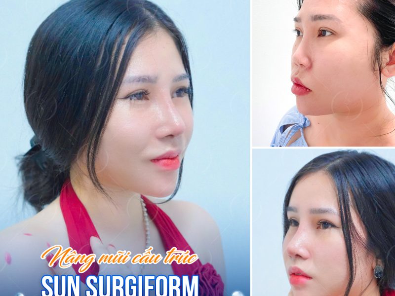 nang-mui-cau-truc-sun-surgiform