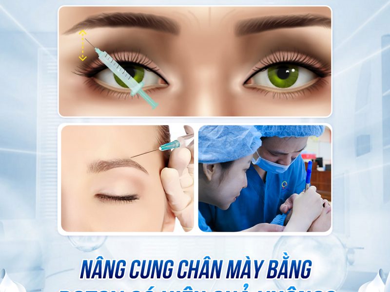 nang-cung-chan-may-bang-botox