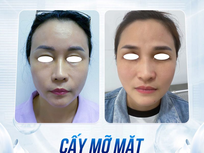 cay-mo-mat-co-giup-tre-hoa-lau-dai-khong
