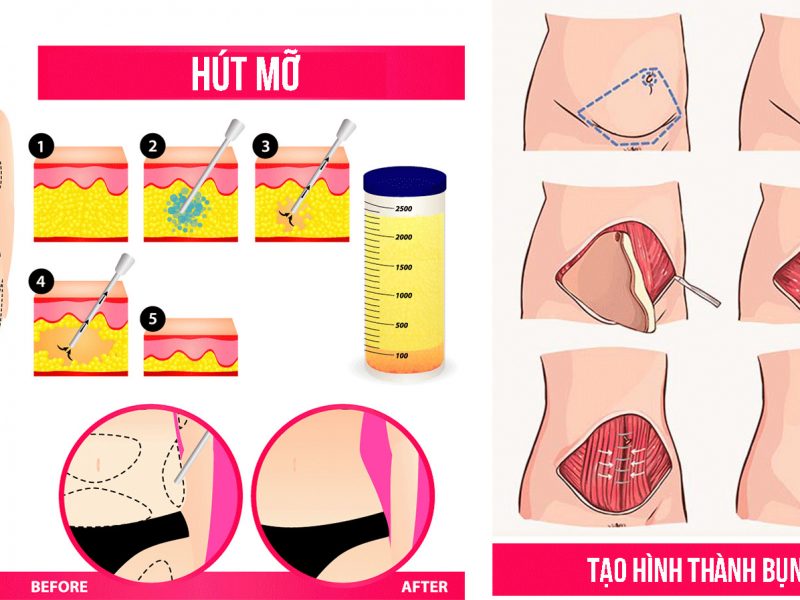 tao-hinh-thanh-bung-khac-gi-hut-mo-bung-