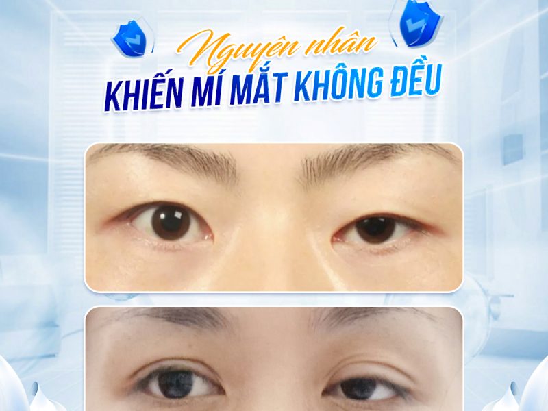 mi-mat-khong-deu-cach-xu-ly-deu-dep-tu-nhien