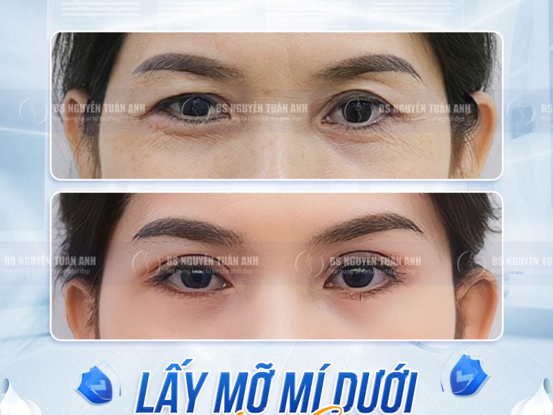 lay-mo-mi-duoi-co-lam-vung-mat-sang-hon-khong-