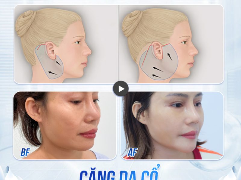 cang-da-co-va-nhung-dieu-can-thiet-khi-thuc-hien