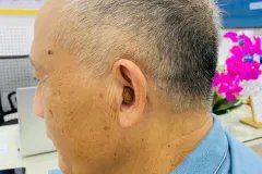 Máy trợ thính làm theo khuôn tai sẽ trông như thế nào?
