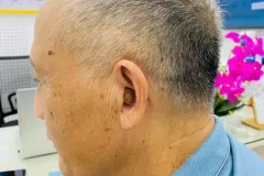 Máy trợ thính khuôn tai tùy chỉnh tại Hưng Yên