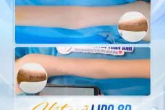 Giải Pháp Cho Bắp Tay Thon Gọn Không Cần Tập Luyện