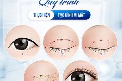 Giải pháp tạo nếp mí tự nhiên cho người bận rộn