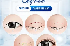 Giải pháp tạo nếp mí tự nhiên cho người bận rộn