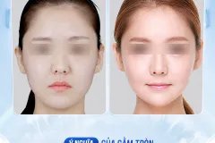 Cằm tròn đầy: Biểu tượng cuộc sống giàu sang viên mãn