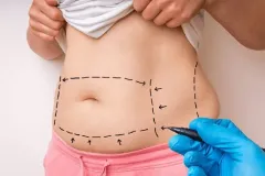 Hút mỡ và da chùng: Giải đáp thắc mắc tại TP.HCM