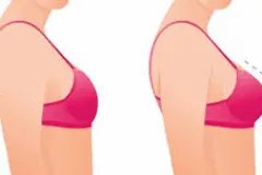 Hành trình hồi phục sau nâng ngực