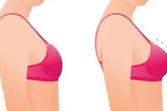 Hành trình hồi phục sau nâng ngực tại TP.HCM