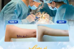Hút mỡ cánh tay có an toàn và hiệu quả lâu dài không?