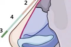 Mũi lộ sóng sau phẫu thì cần sử dụng phương pháp nào?