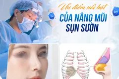 Nâng mũi sụn sườn có bền lâu không