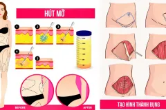 Tạo hình thành bụng và hút mỡ bụng tại TP.HCM