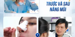 Nẹp mũi sau phẫu tại TP. Hồ Chí Minh