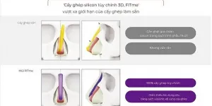 Nâng mũi 3D Fitme tại Thành phố Hồ Chí Minh