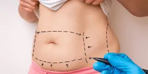 Hút mỡ và da chùng: Giải đáp thắc mắc tại TP.HCM