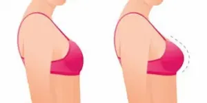 Hành trình hồi phục sau nâng ngực